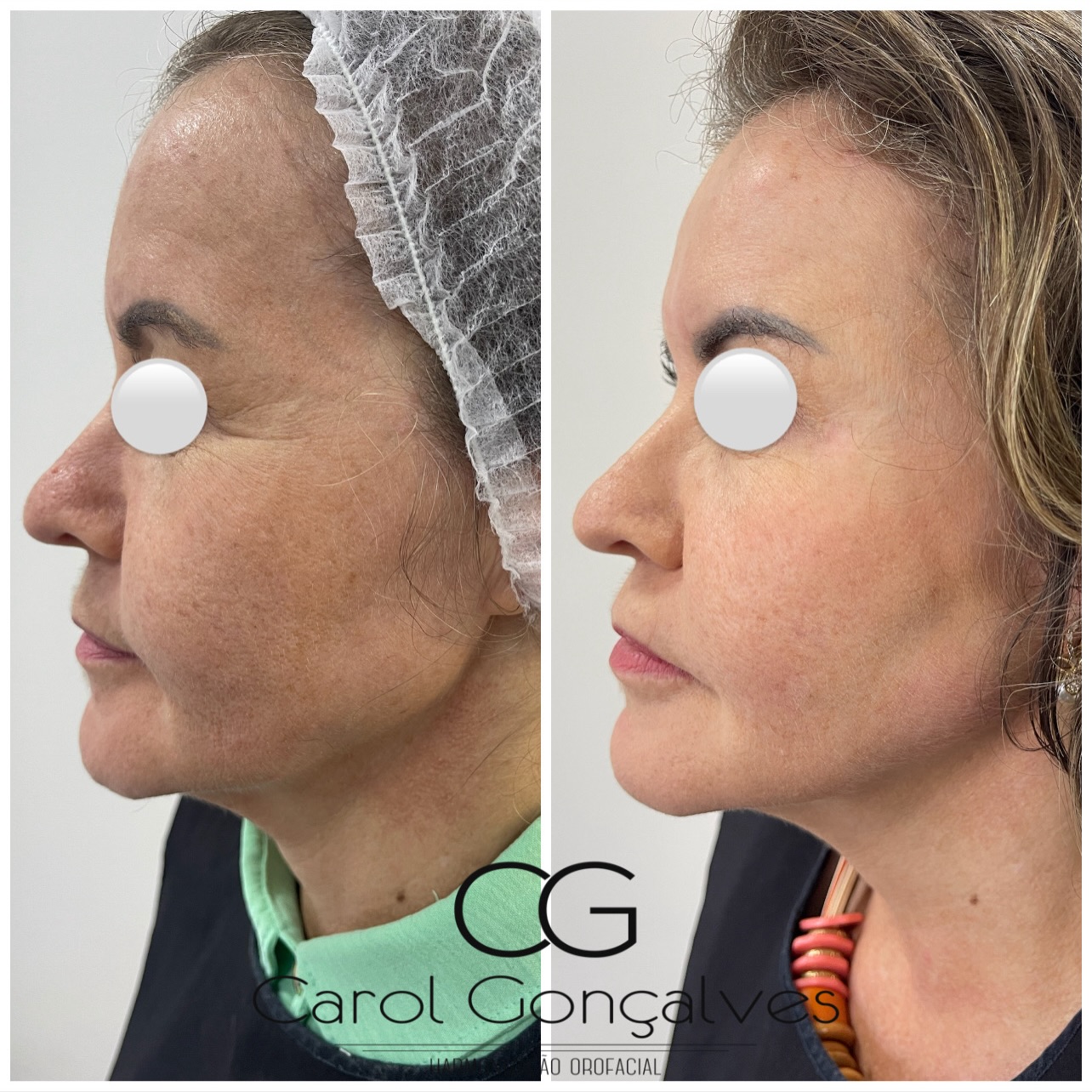 Resultado de harmonização facial — perfil antes e depois