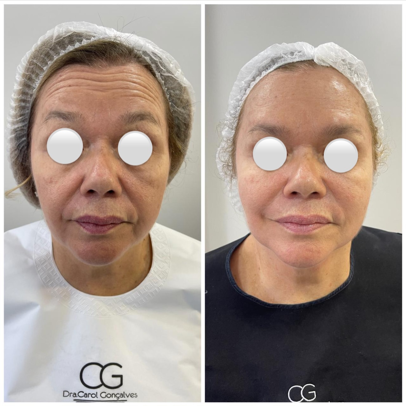 Resultado de harmonização facial — vista frontal antes e depois