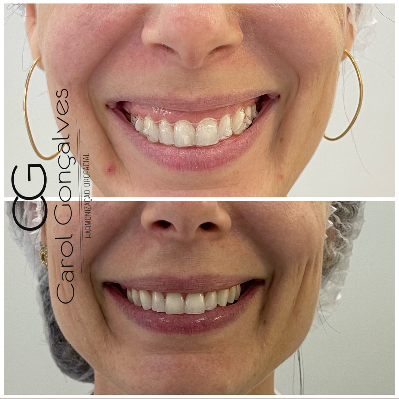 Resultado de estética do sorriso — antes e depois